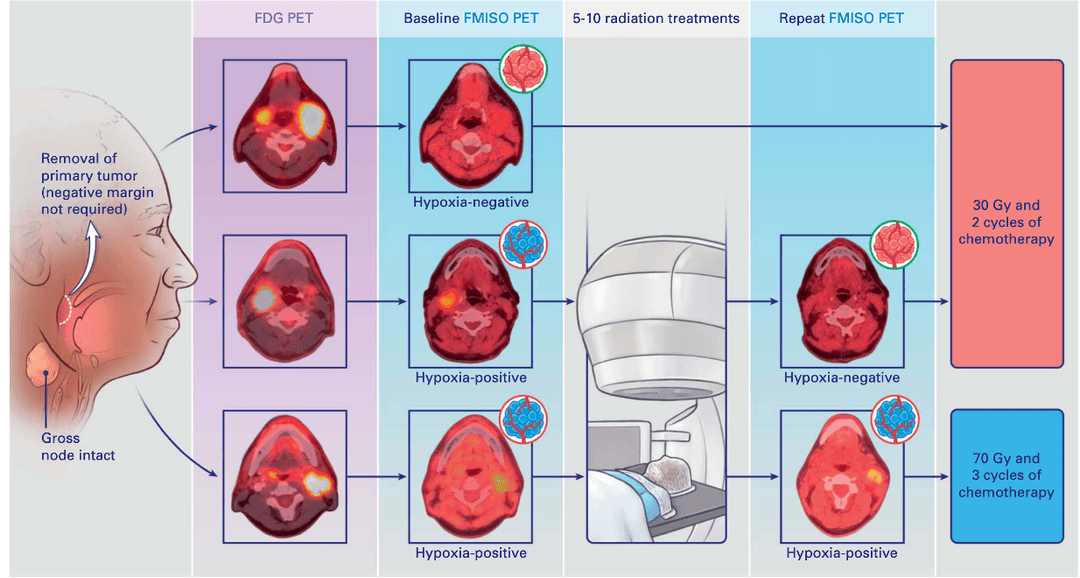 Dose distribution graphic from reduced-dose HPV radiotherapy